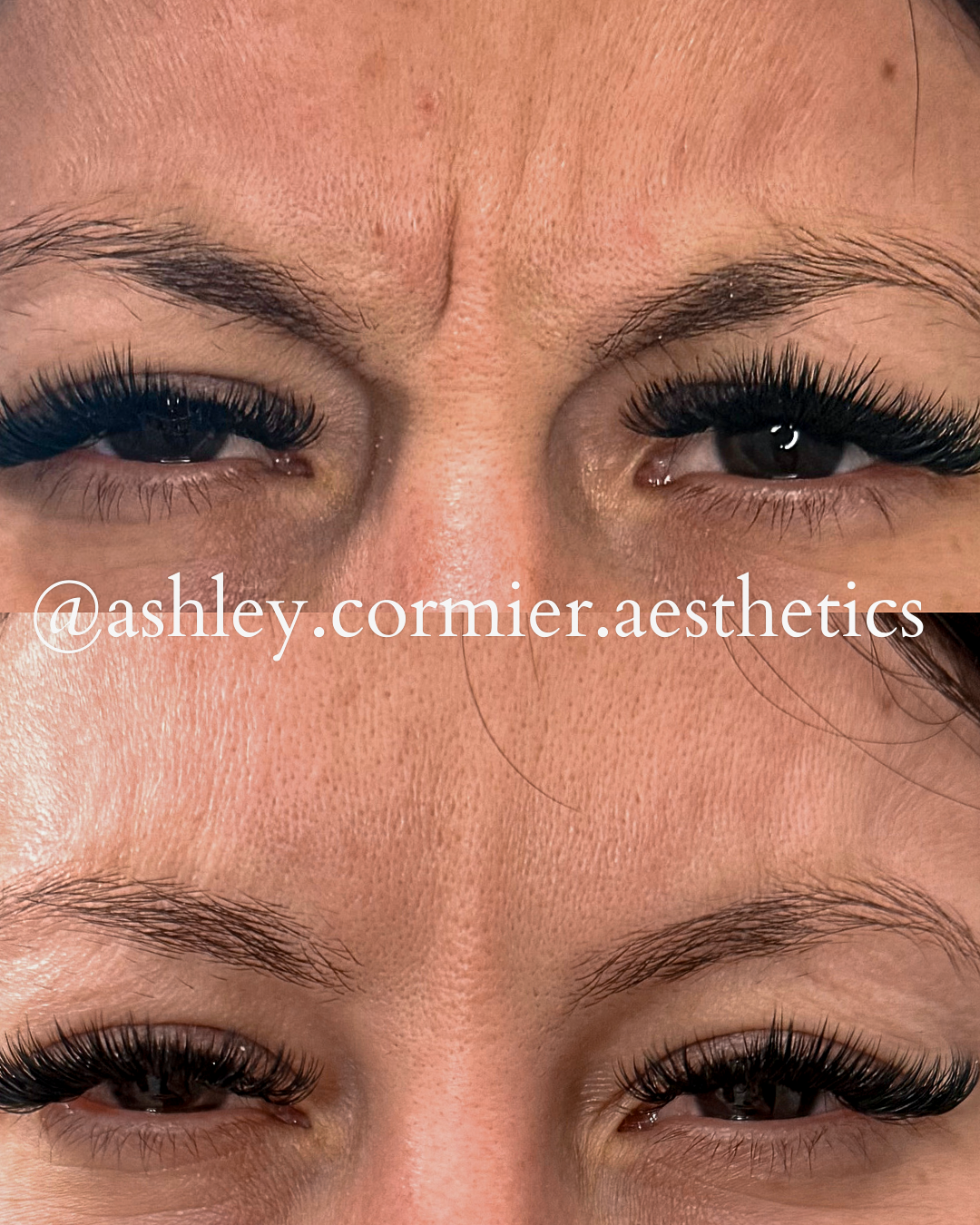 glabella botox