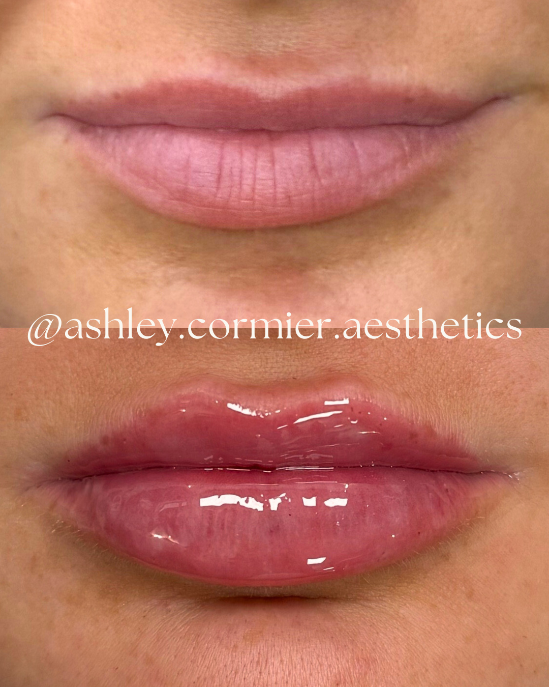 before and after a half syringe of lip filler