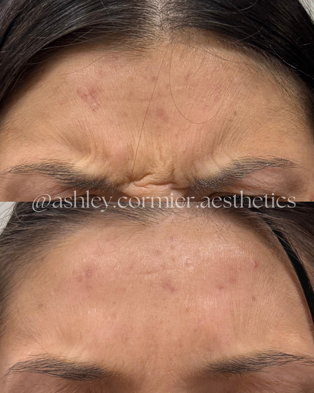 before and after glabella botox