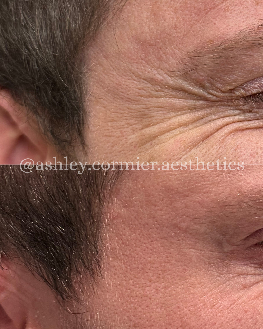 before and after crow's feet botox