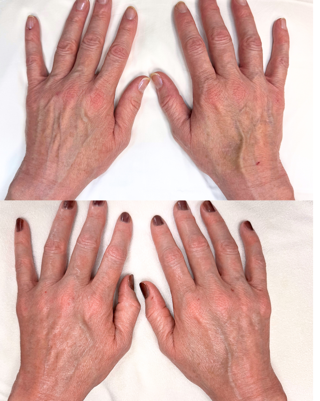 Hand rejuvination - IPL and Skinvive