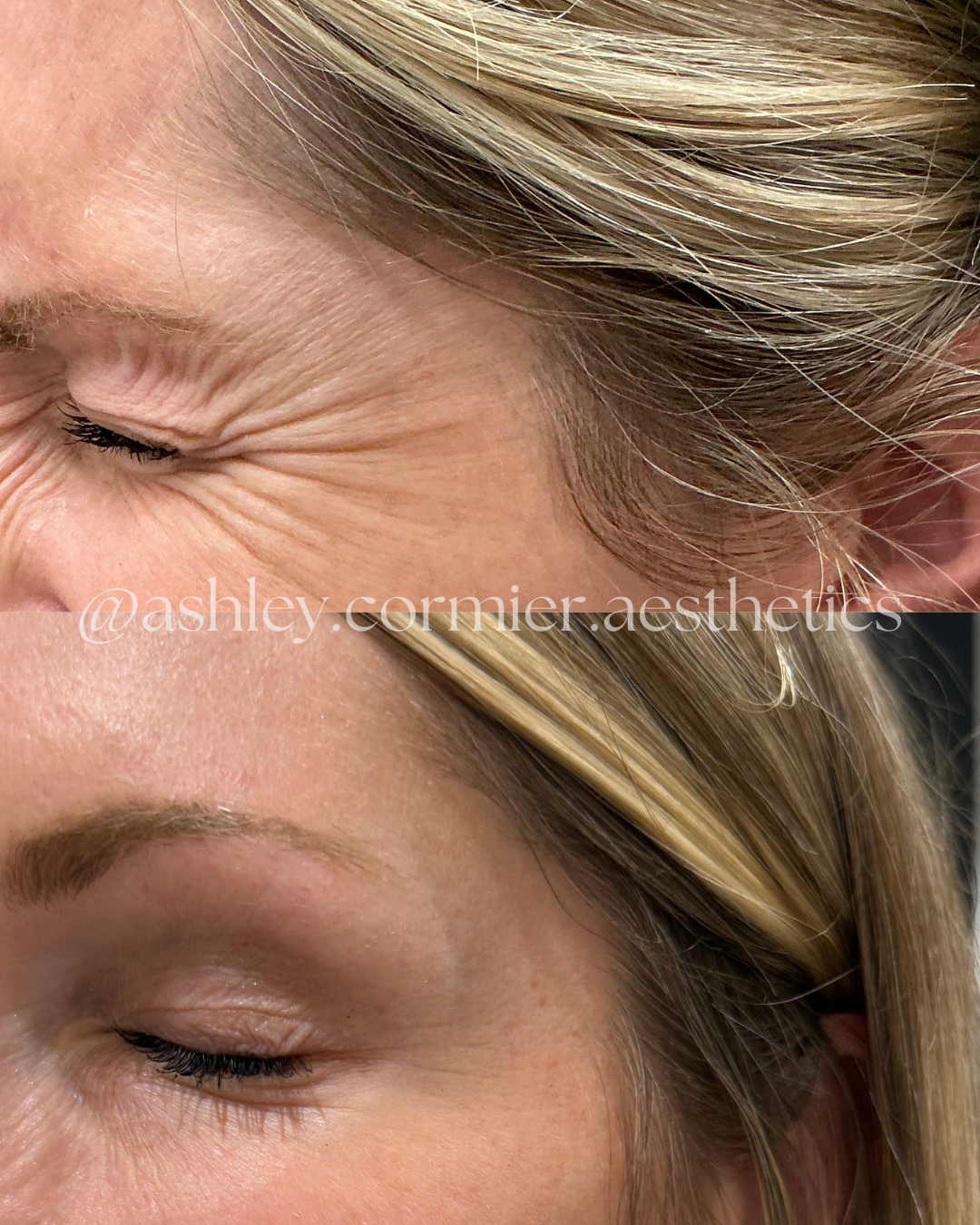 before and after crow's feet botox