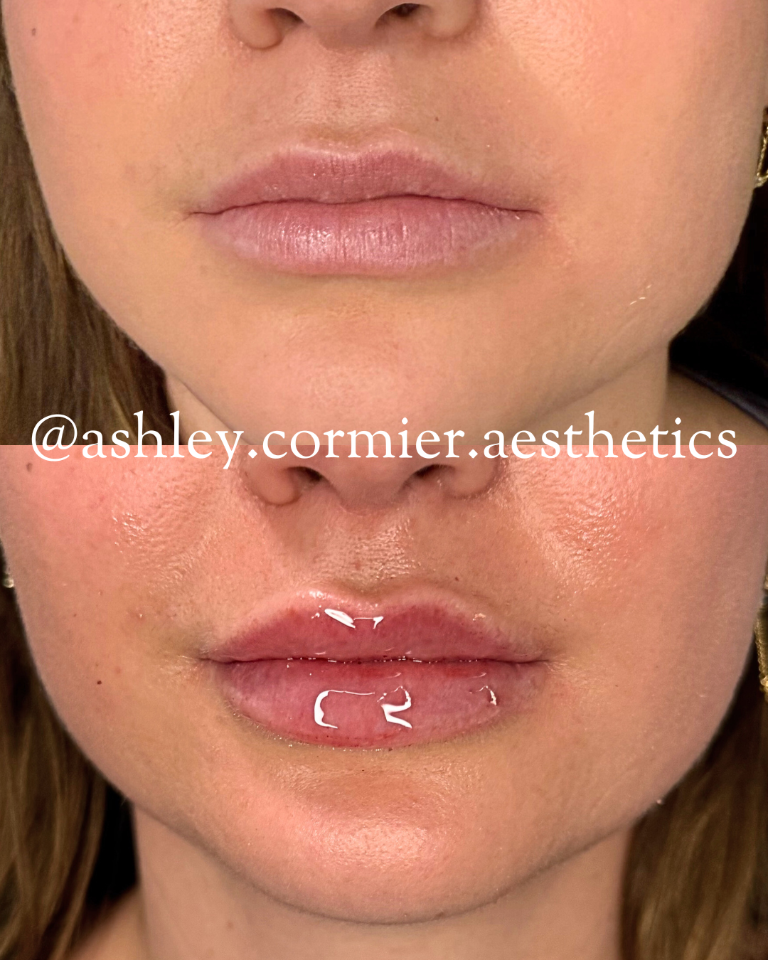 before and after a half syringe of lip filler
