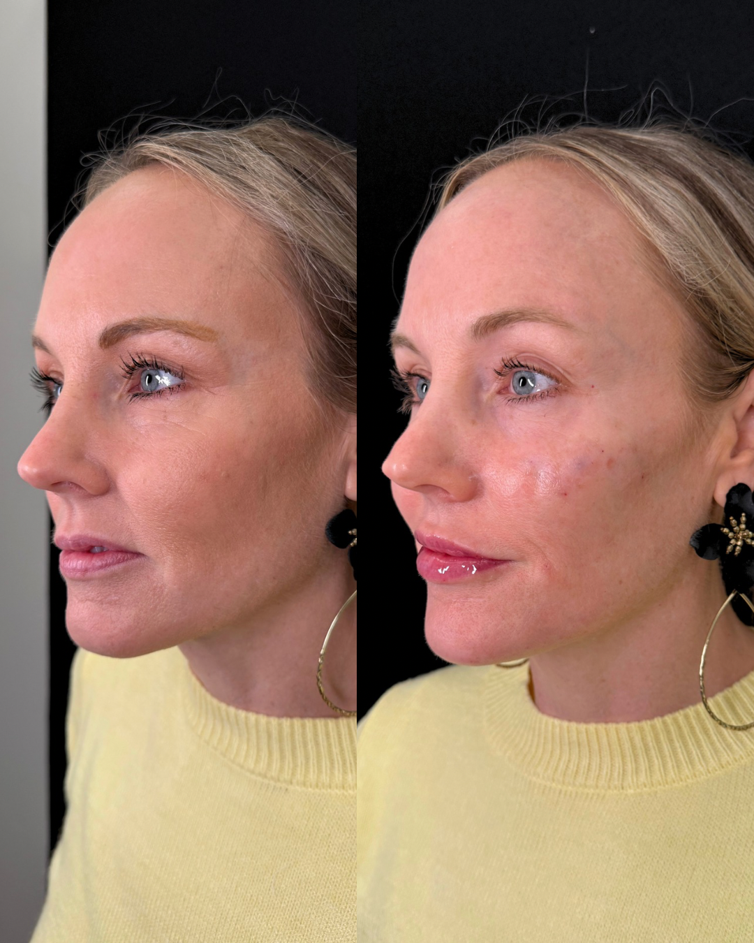 full facial balancing results, cheek, chin, and lip filler, upper face botox