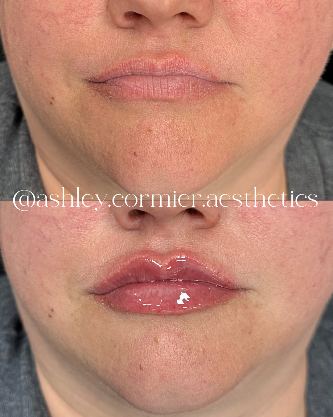 before and after a half syringe of lip filler