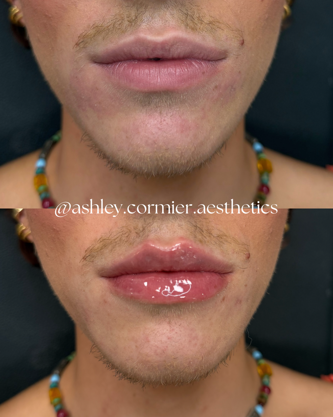 before and after a half syringe of lip filler