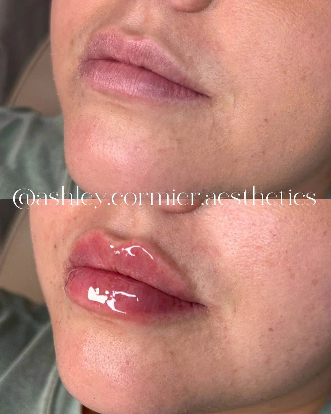 before and after a half syringe of lip filler