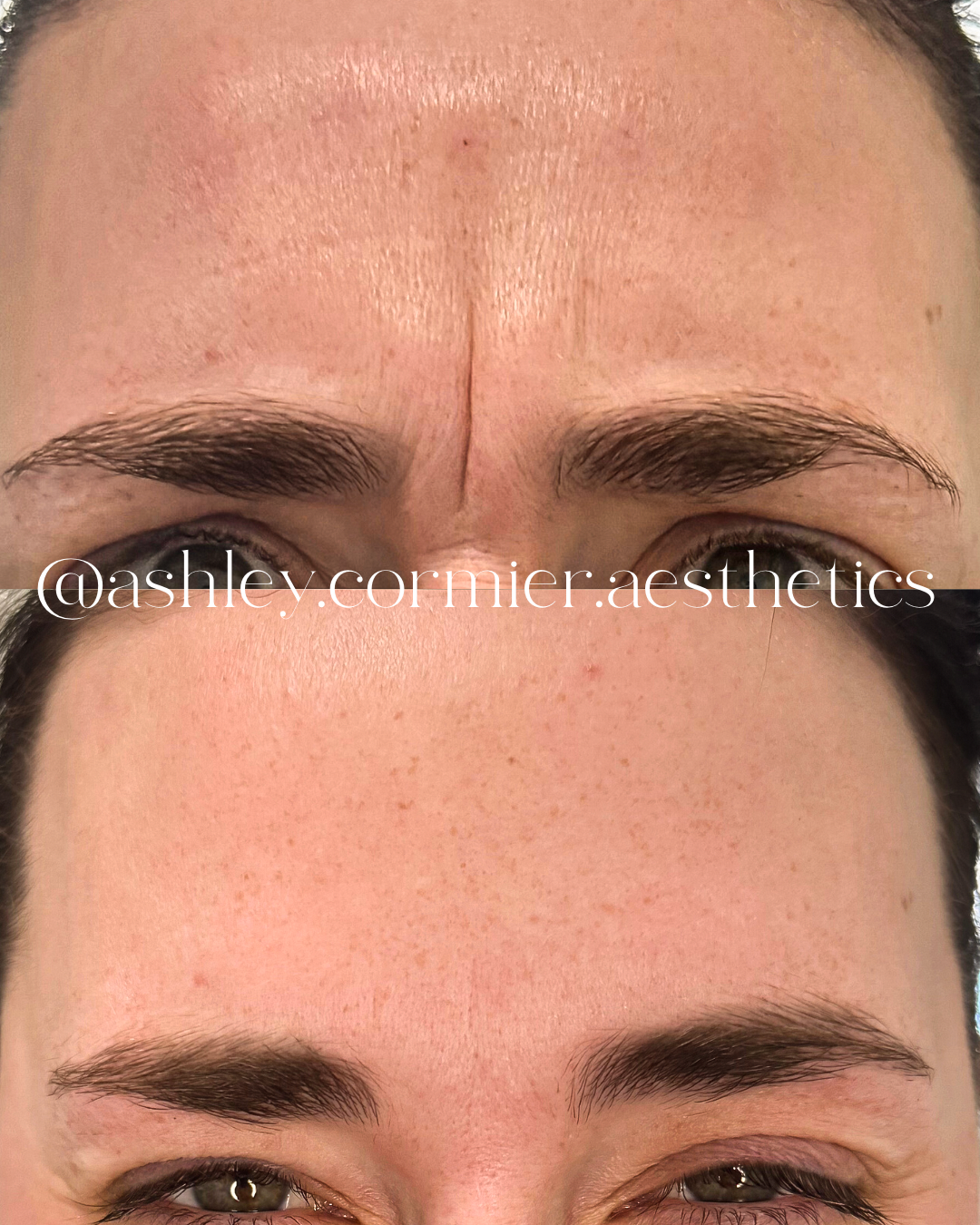 glabella botox