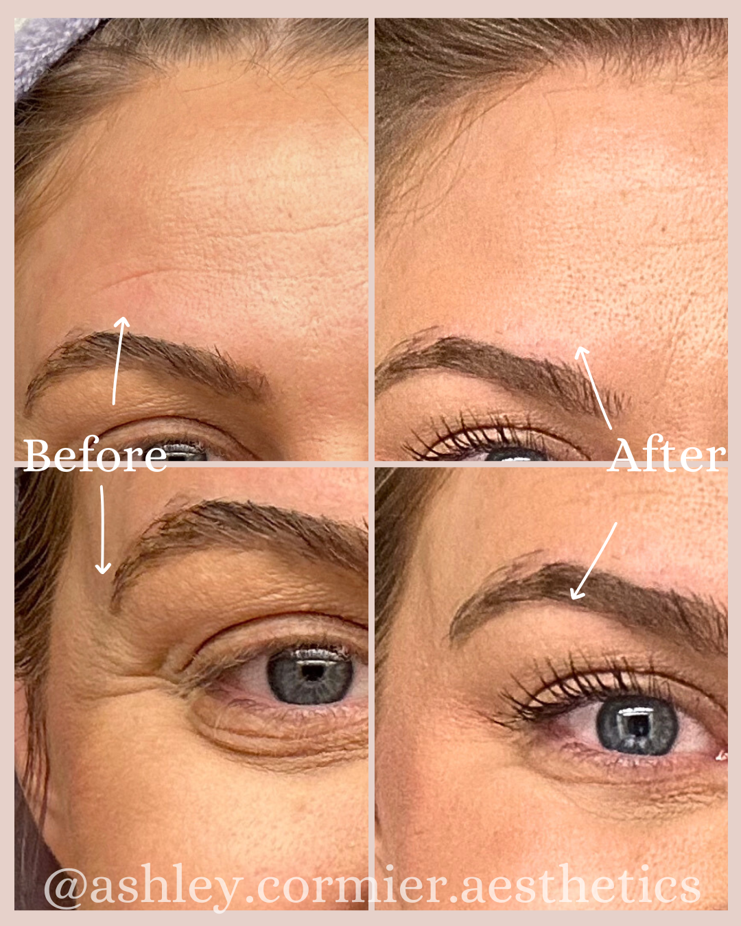 Forehead and crow's feet Botox