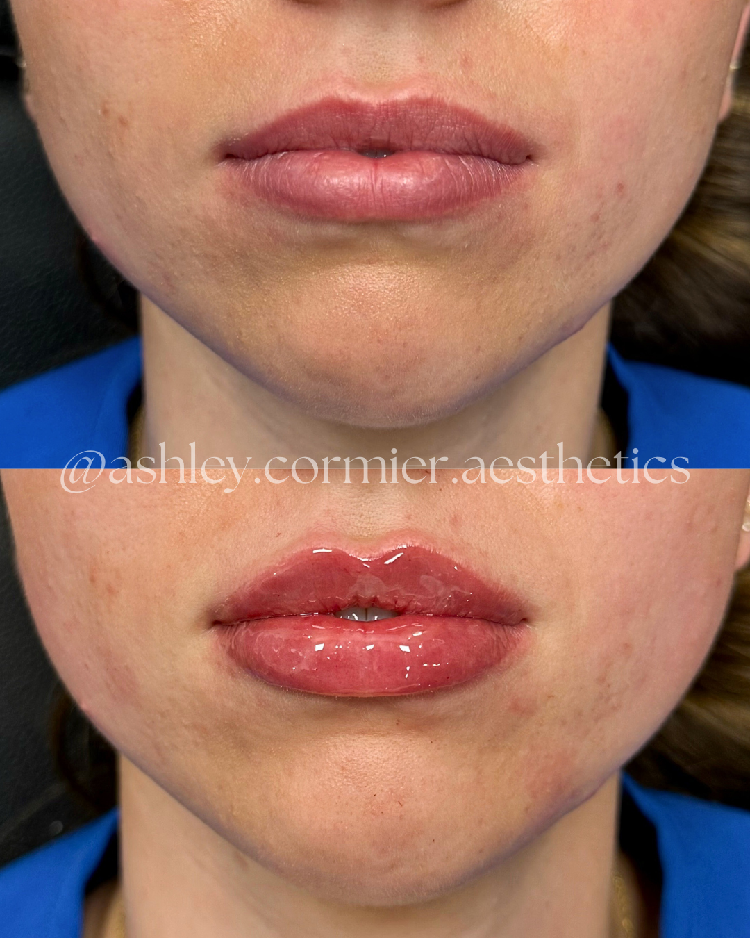 before and after a half syringe of lip filler