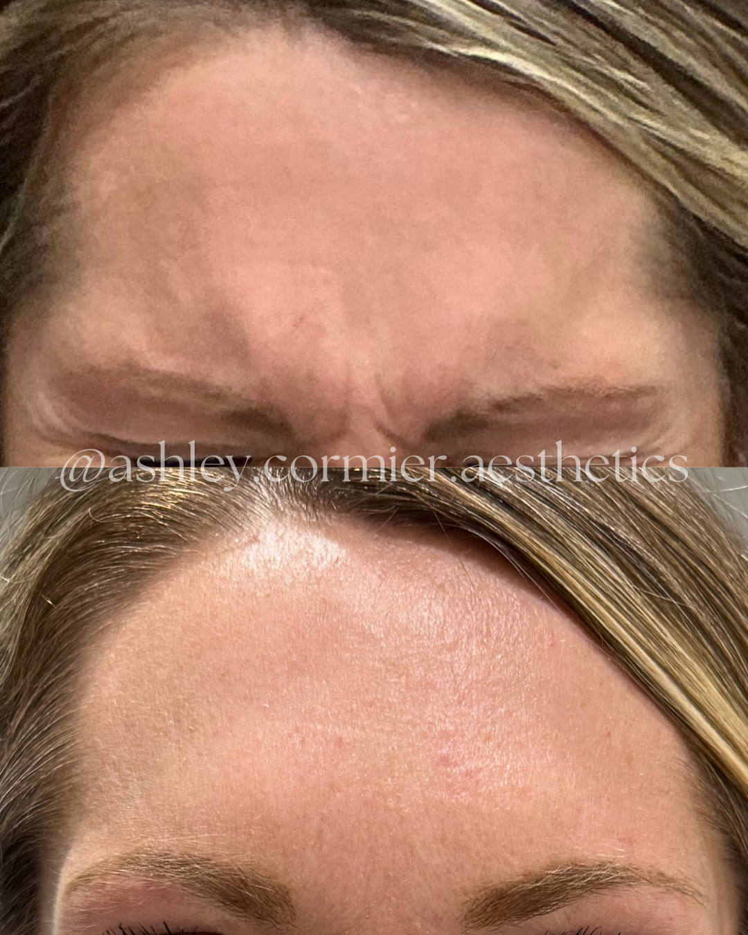 before and after glabella botox