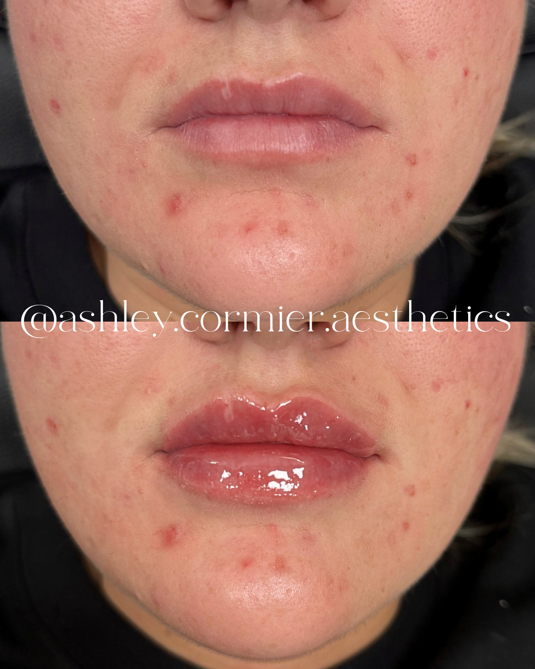 before and after a half syringe of lip filler