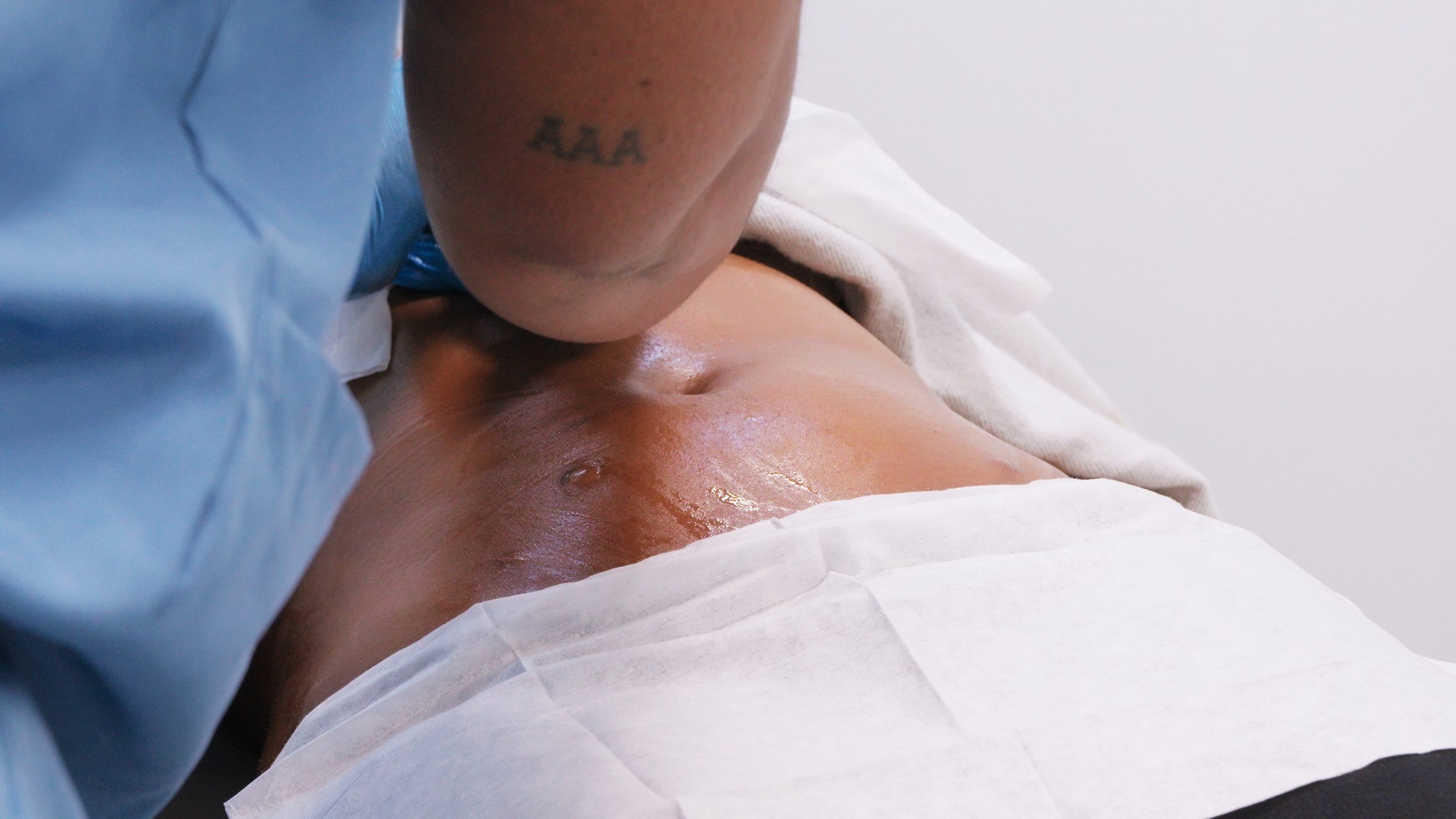 A person receiving a medical or cosmetic procedure on their abdomen while lying down, with a healthcare professional performing the procedure.