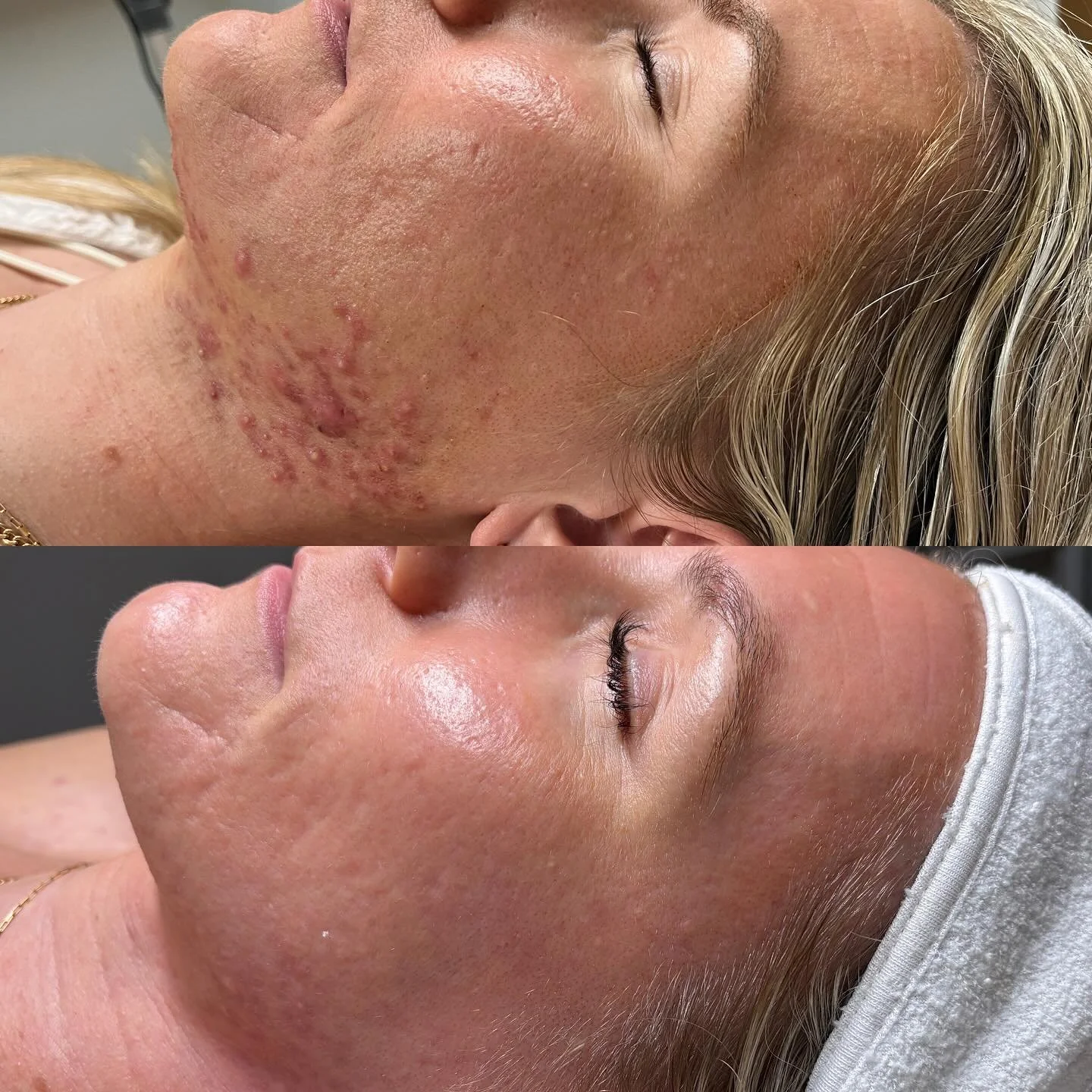 𝒜𝒸𝓃𝑒 𝐵𝑜𝑜𝓉𝒸𝒶𝓂𝓅 𝒯𝓇𝒶𝓃𝓈𝒻𝑜𝓇𝓂𝒶𝓉𝒾𝑜𝓃

It&rsquo;s amazing what a customized skincare routine and treatment plan can do for you! 🫧💫