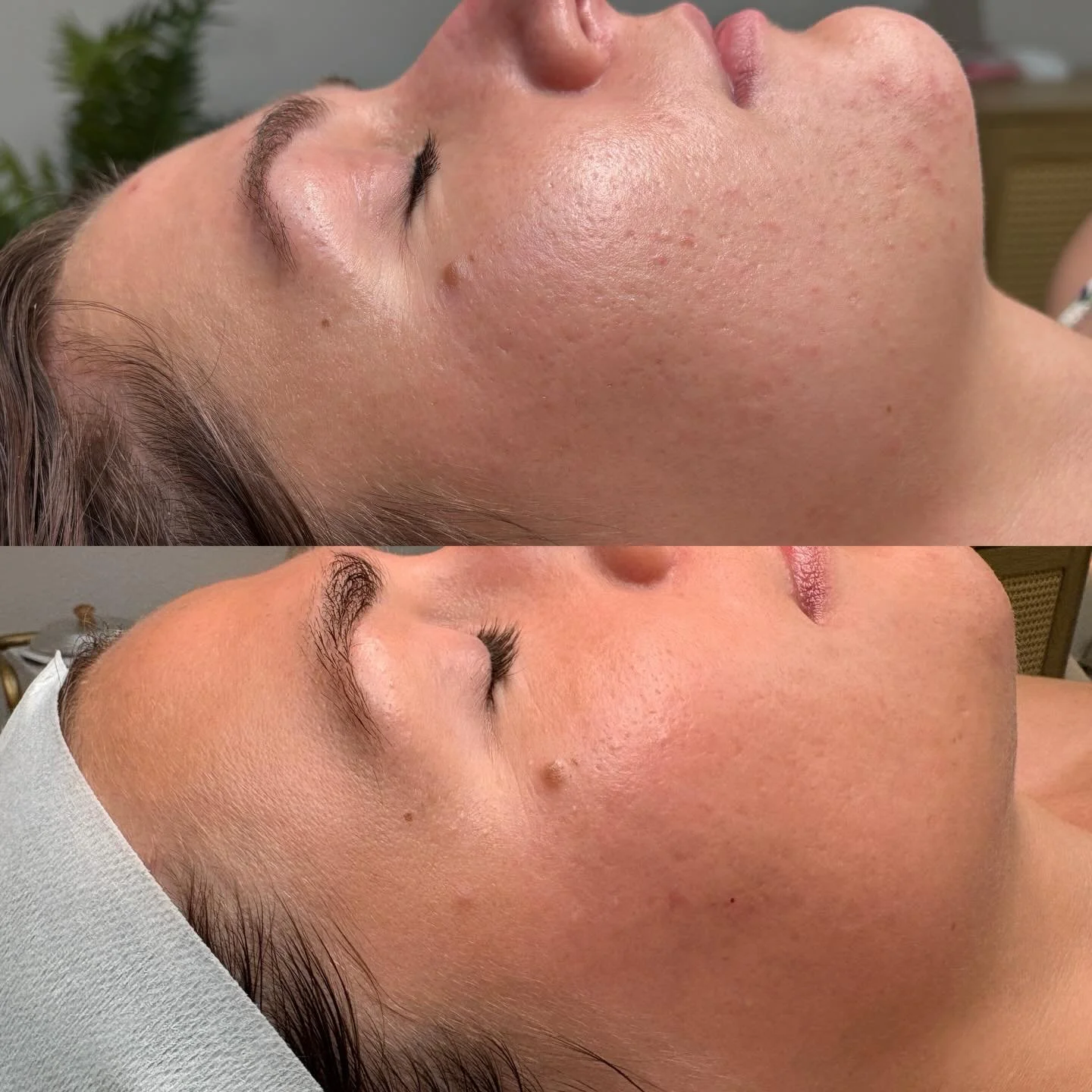 Acne Bootcamp before and after 🫶🏻 so proud of her and her results! 

Next step is to treat leftover scarring ✨