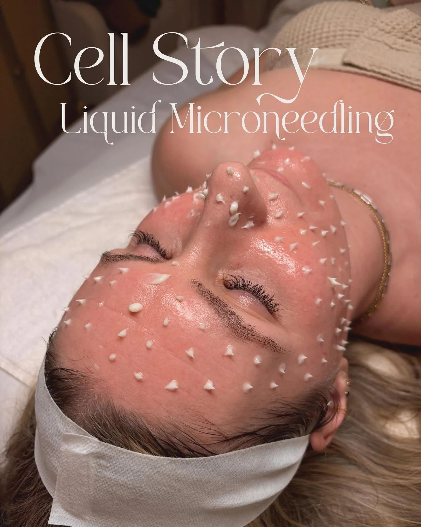 The magic of Cellstory is its patented microscopic needles derived from hydrolyzed sponges!

Cellstory uses 50,000 &ldquo;microspears&rdquo; in one treatment! These microspears create microchannels in the skin.

A needle-free, more gentle option but 