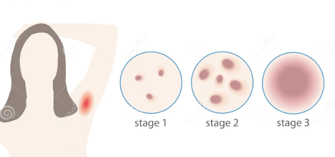 Hidradenitis Suppurativa Stages and Severity: Mild, Moderate, or Severe?
