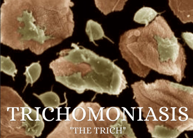 What Is Trichomoniasis? Symptoms, Treatment, and Fertility Risks