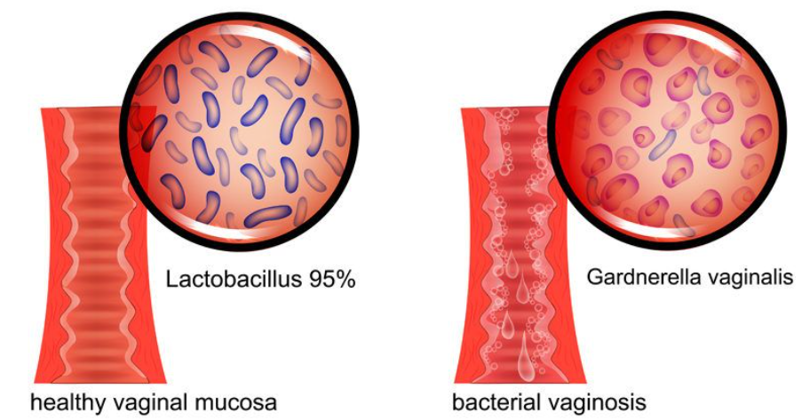 What Is Gardnerella? The Bacteria at the Center of BV Explained