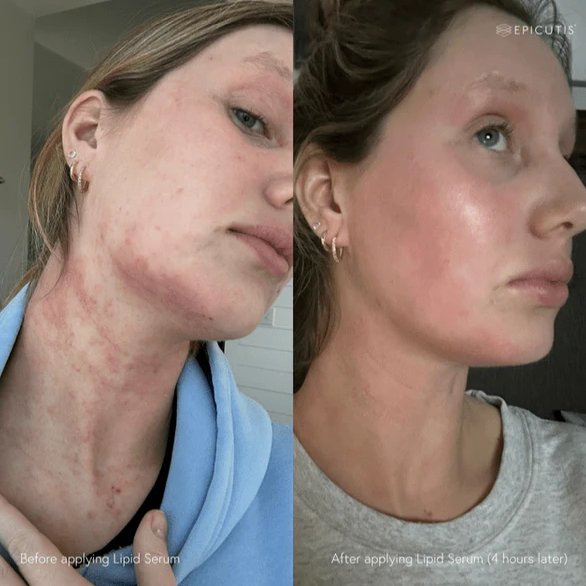 epicutis-lipid-serum-3806338.jpg