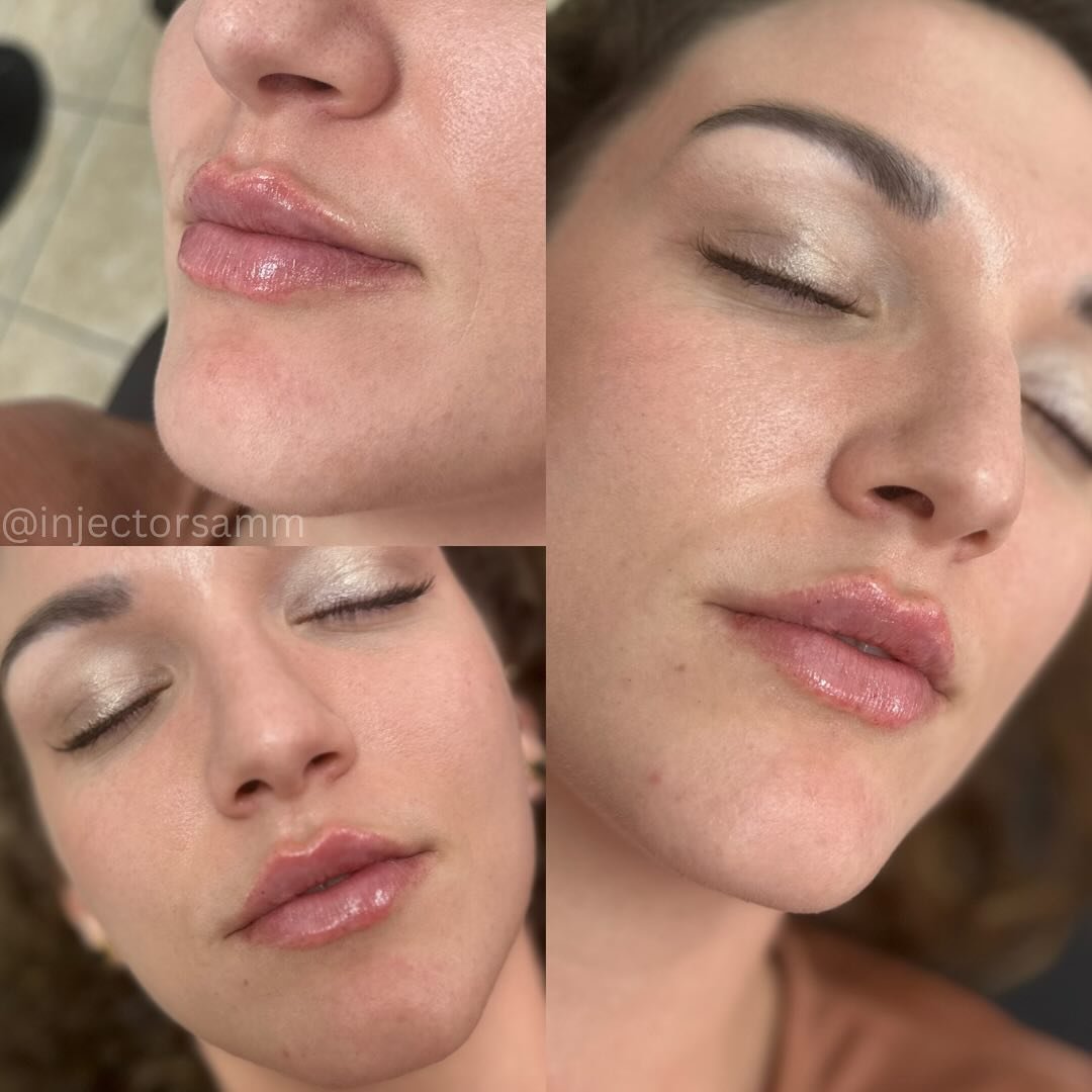 VERSA Vibes 💉👄

Versa Lips are currently $350 that&rsquo;s a $600 value! 

Dm to book