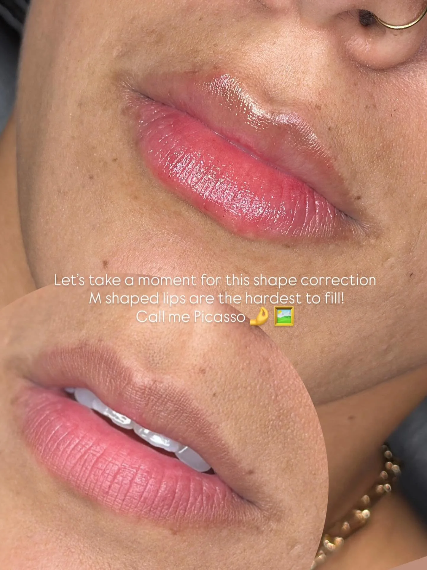 Ugh absolutely gorgeous 🥹🤌 

Lip Filler $349