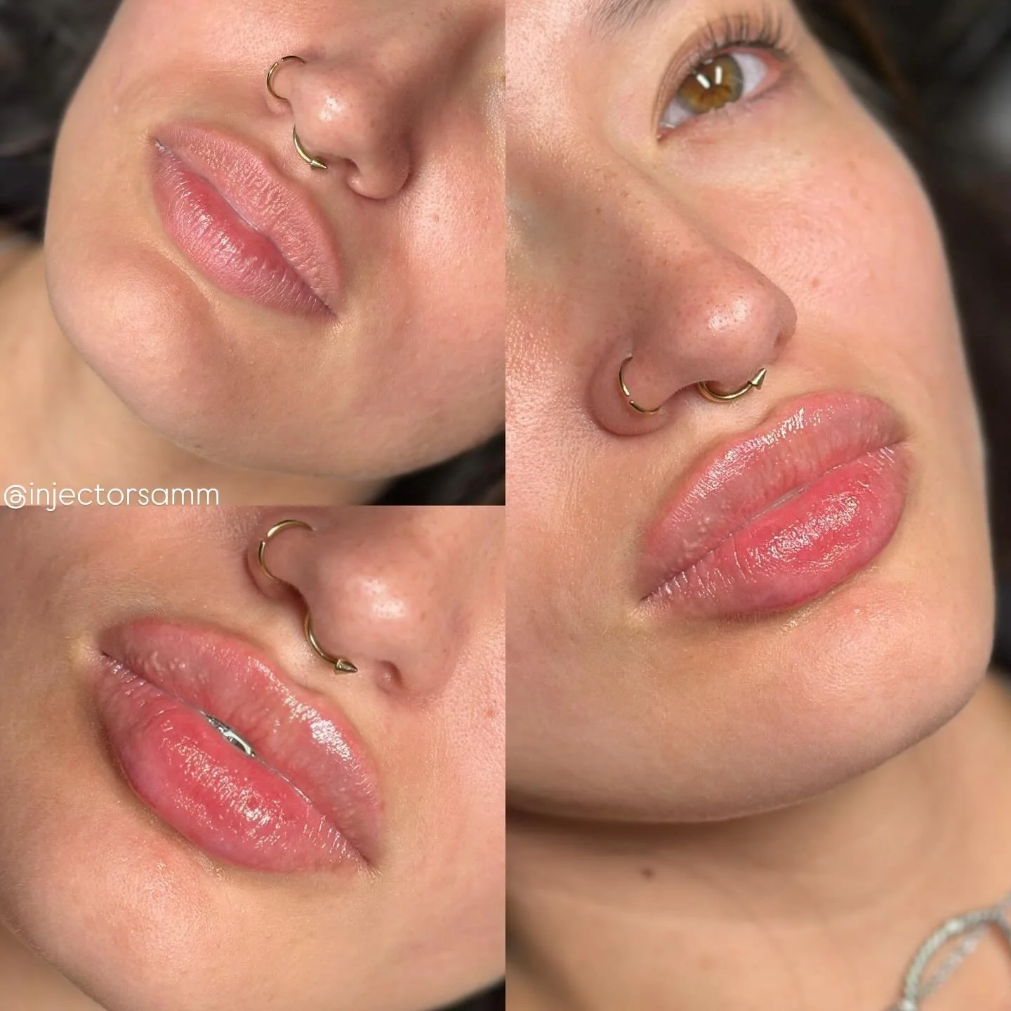 Absolutely beautiful! 1ml of versa for this beauty 

Lip filler $350 with model discount
