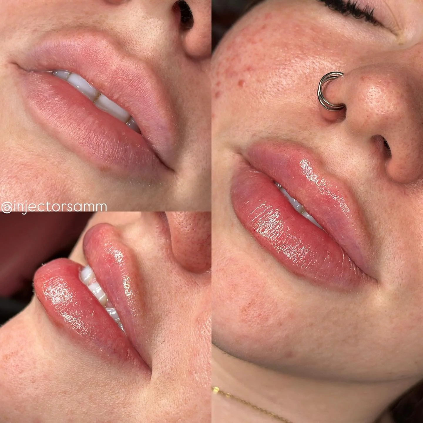 I love a good plump lip 👄❤️ my lip goals 🥲
Lip Filler $349