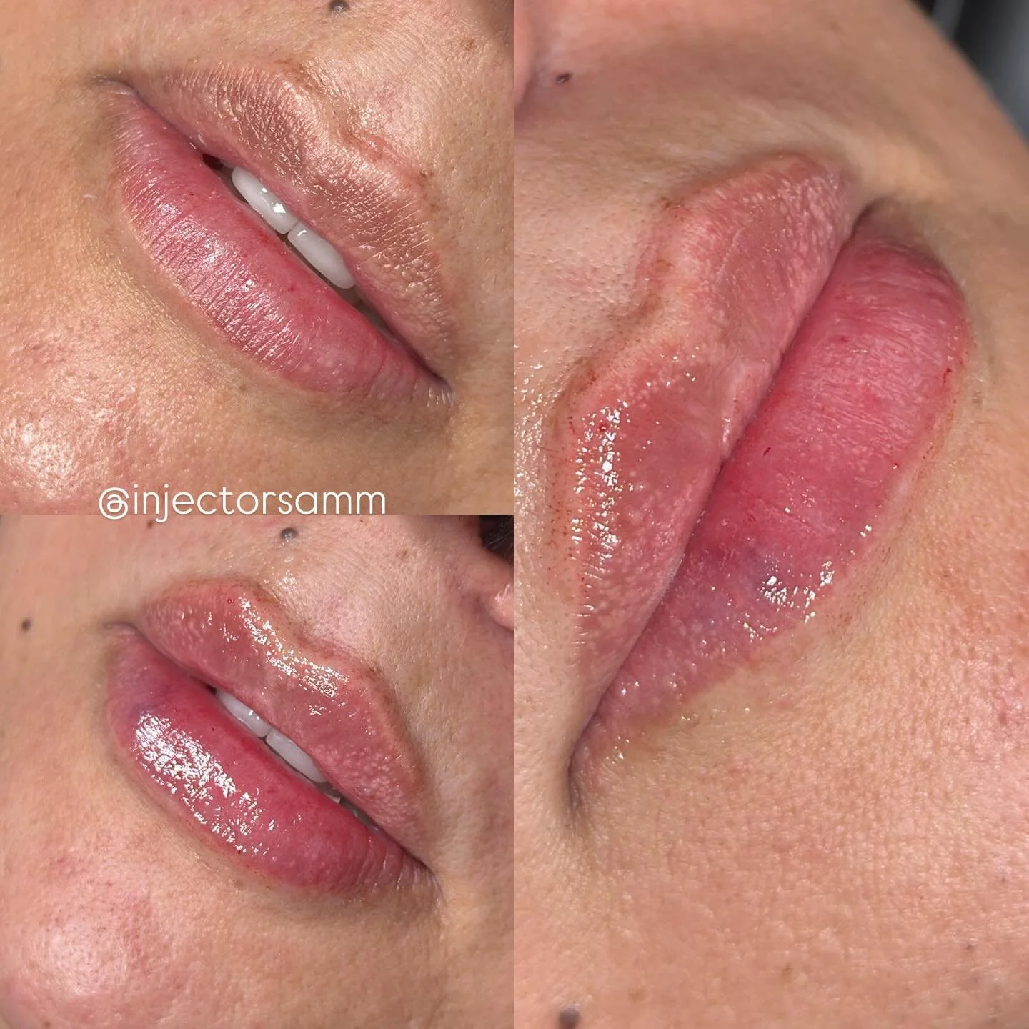 subtle. sculpted. stunning. 💎 a mini lip plump placed with precision is a masterpiece in itself&mdash;call me picasso 🖌️💋 #LuxuryAesthetics #MiniPlumpMagic #SpaLina

Mini lip $250