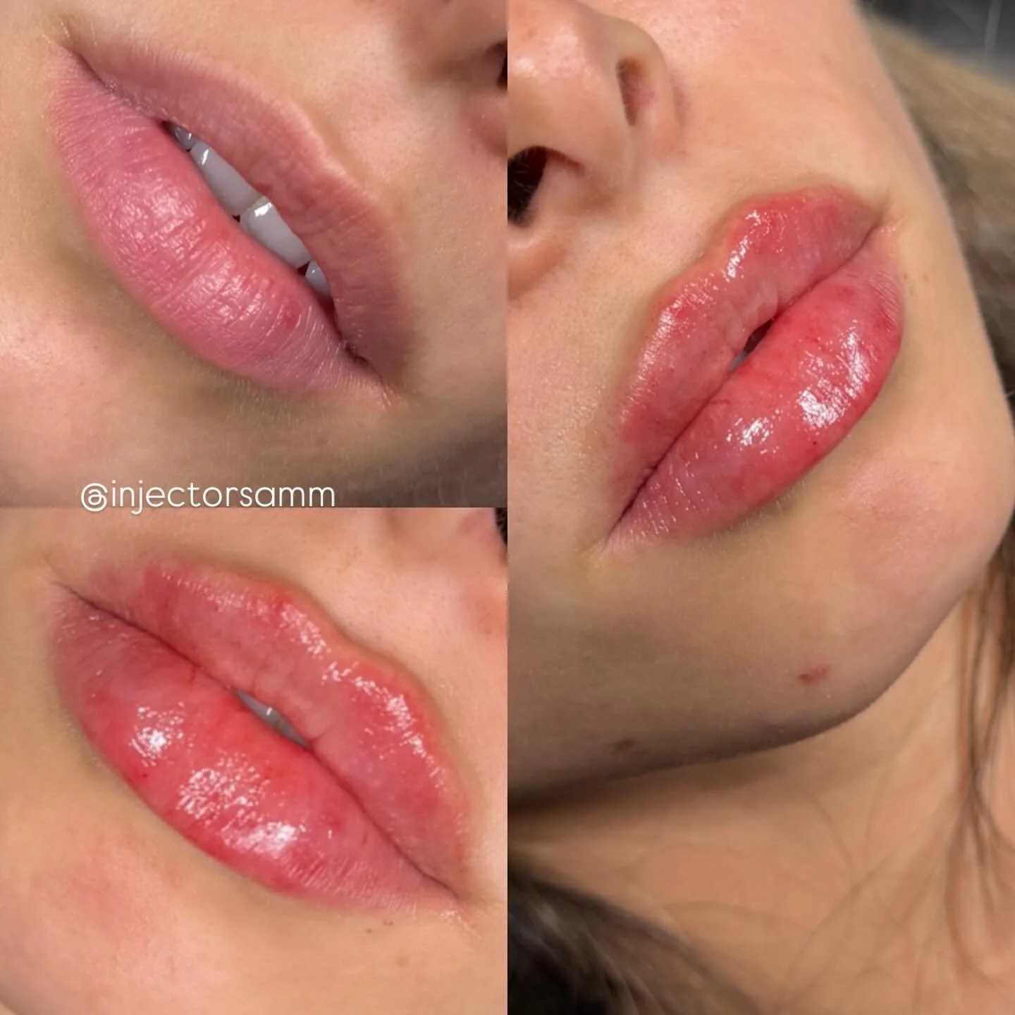When your lips say main character energy 😘
Before ➡️ After &mdash; only $349 this month

Book at spalinatx.com

#LipsBySamm #LipFillerDeals #SpaLinaTX #FillerTransformation #SanAntonioBeauty #JuicyLips