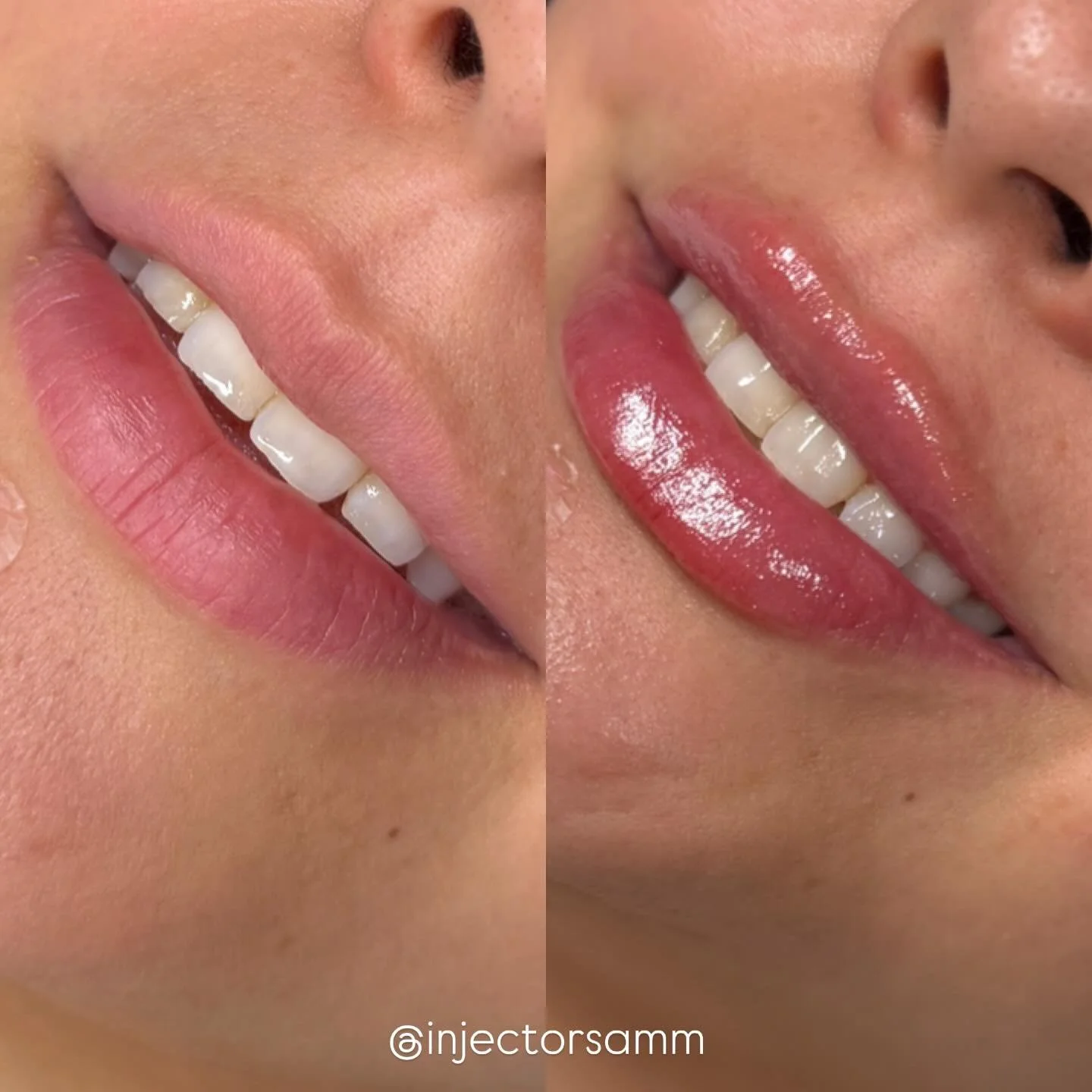 Pretty and plump 

$349 Lip filler October Special 🎃