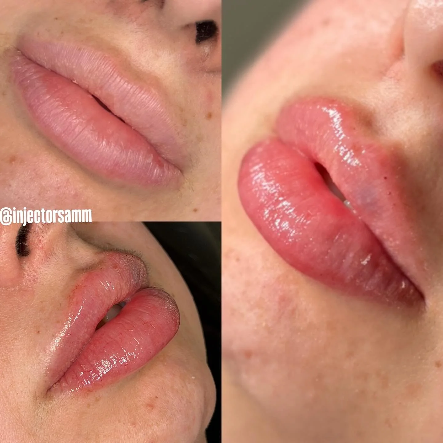 $349 Lip Filler 🎃