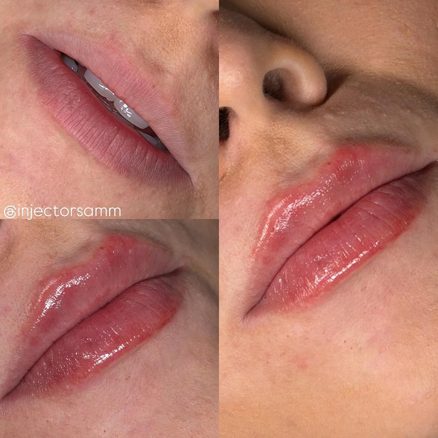 Guys Lip Filler will only be $349 until October 31st book now !