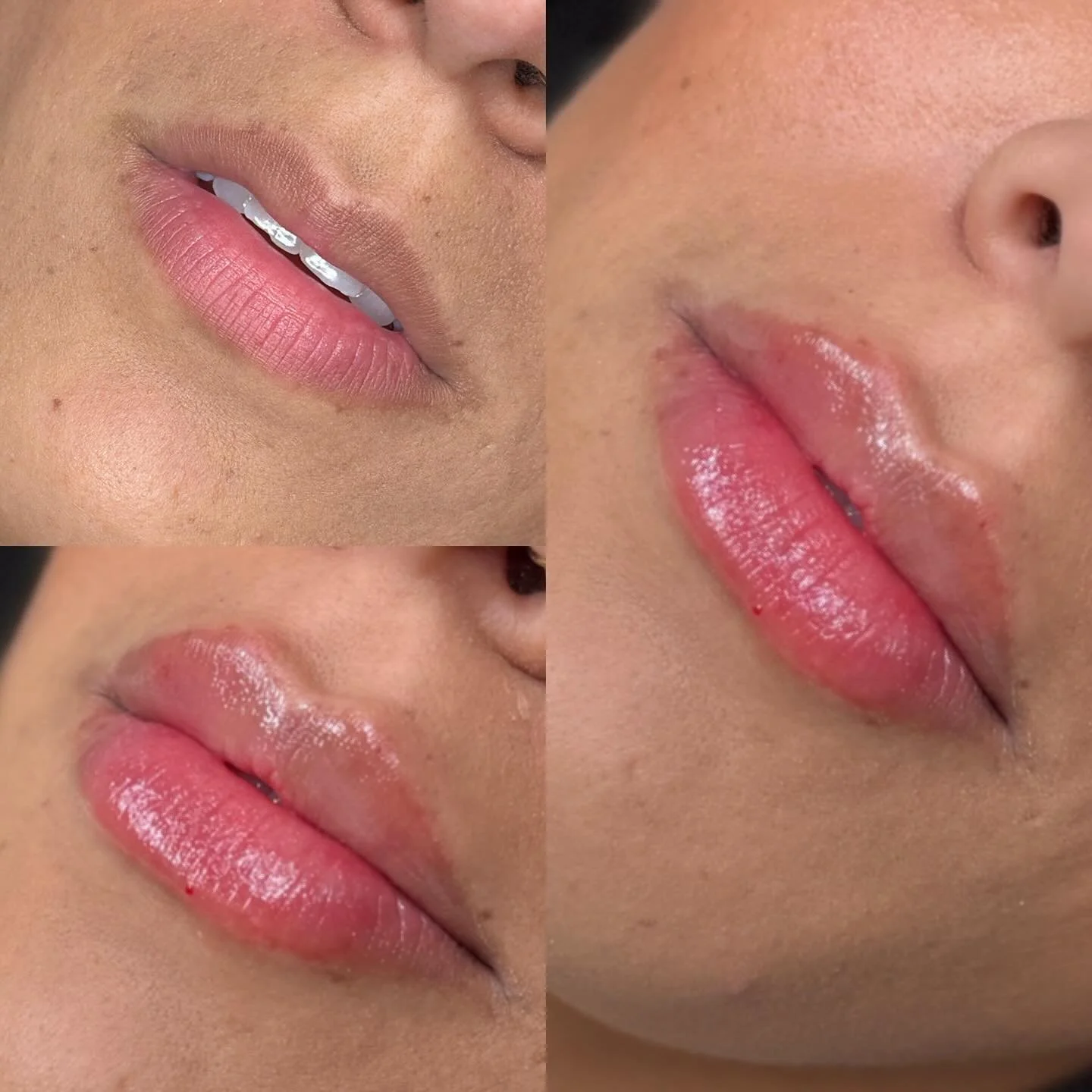 Last few appointments available this week for the $349 Lip Filler Spacial 🫶