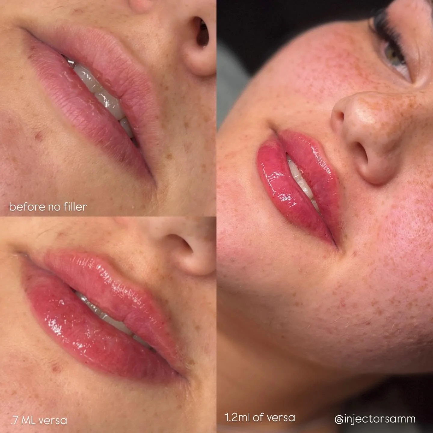 When your injector says &ldquo;trust the process&rdquo; this is what they mean 💁🏻&zwj;♀️

Two sessions and beautiful results 🩷

$399 versa 
$599 juvederm