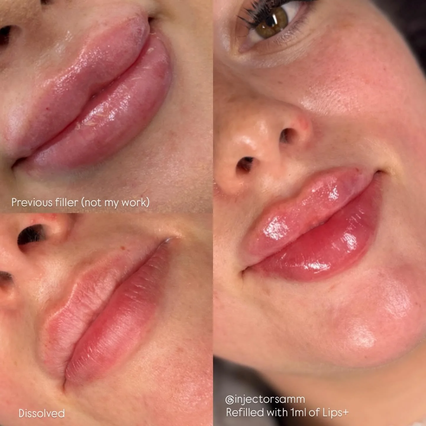 From migrated to mastered 💉➡️💋
Step 1: Dissolve old filler.
Step 2: Let the tissue rest.
Step 3: Refill using proper depth + technique.

This is how we restore a true lip shape ✨

I specialize in lip filler corrections + difficult cases &mdash; whe