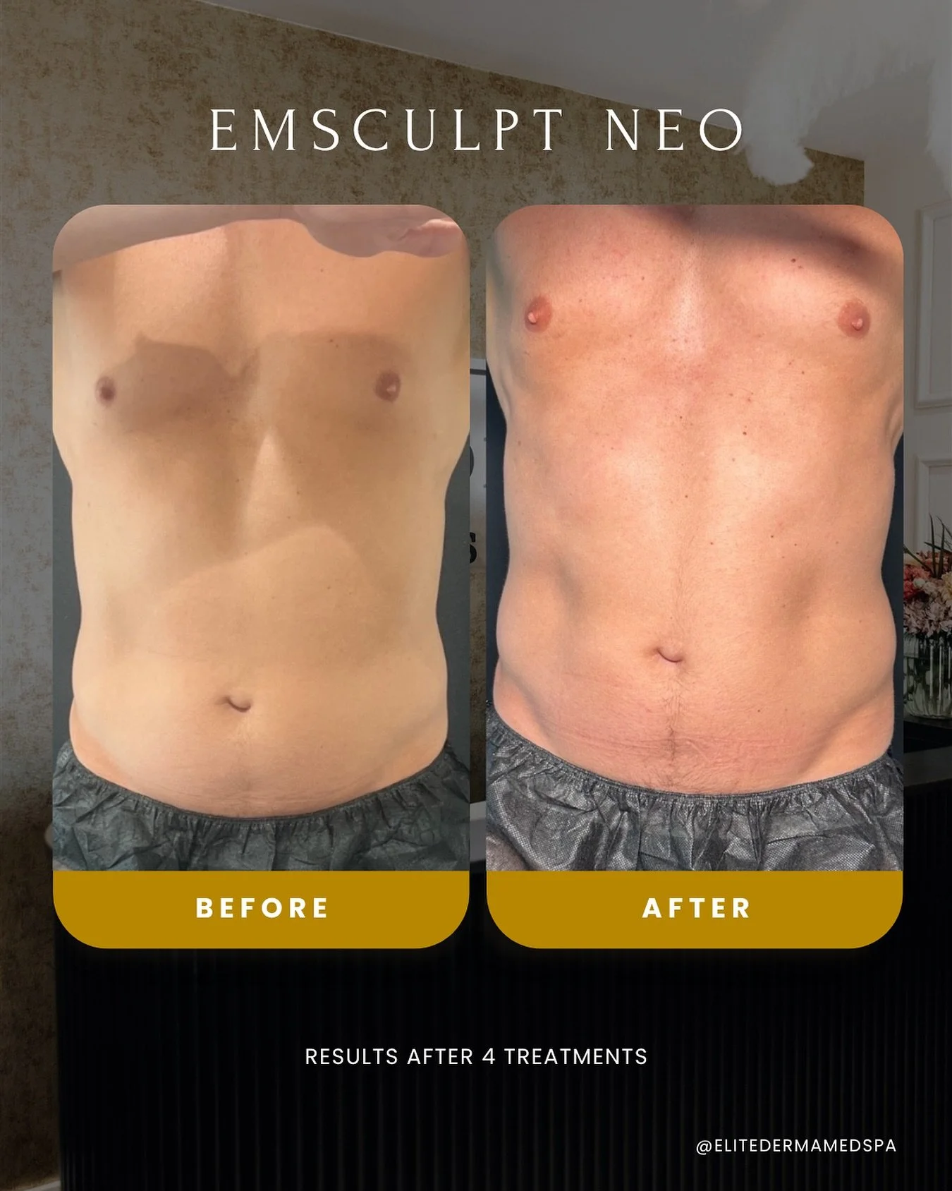🔥 More definition, less effort.
After just 4 sessions of Emsculpt Neo, this client saw a visible change in their core and flanks. The treatment combines HIFEM and radiofrequency to burn fat while building muscle&mdash;great for sculpting those areas