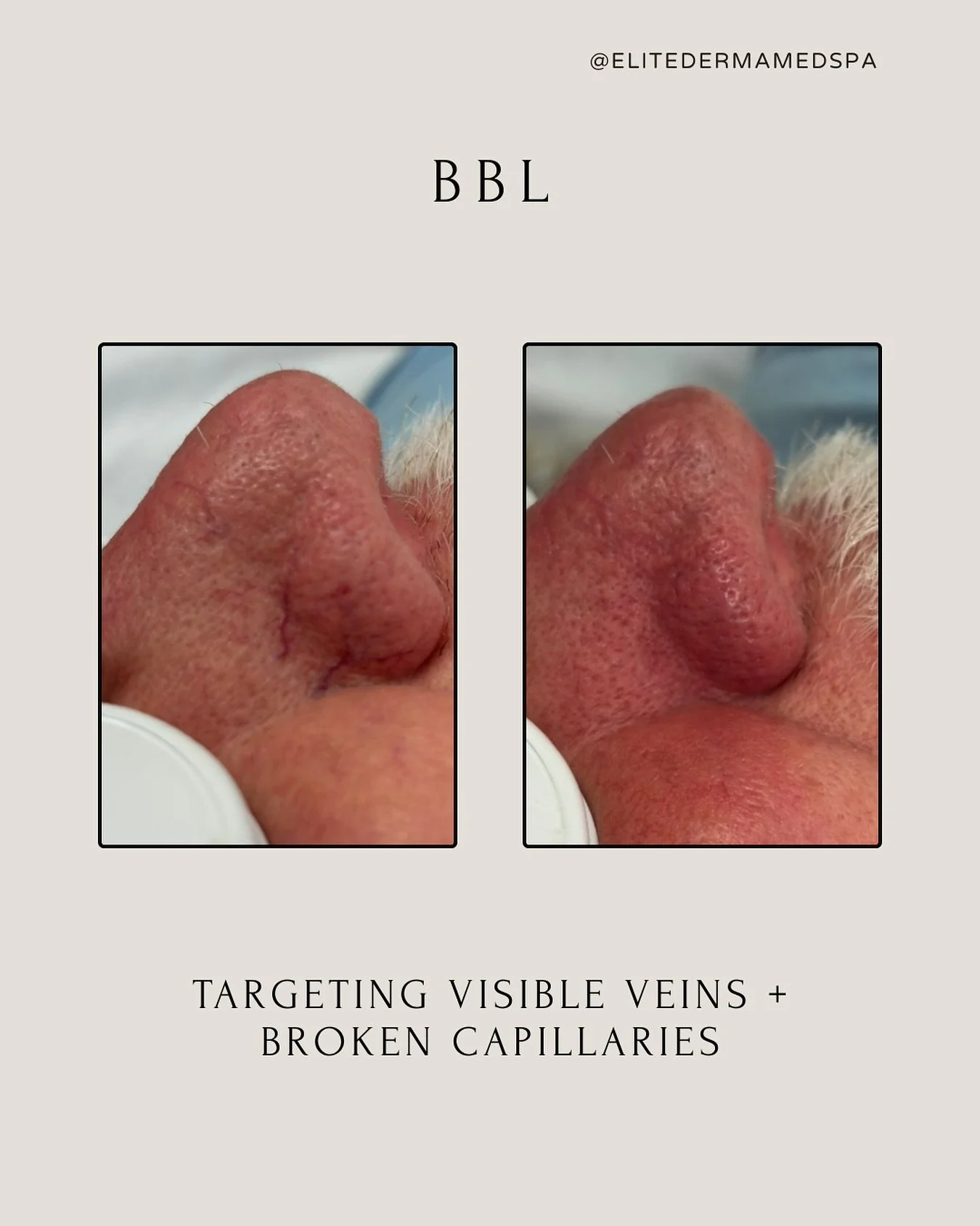 ✨ Goodbye redness, hello confidence.
BBL targets visible veins + broken capillaries around the nose, leaving skin clear and even-toned. This gentleman&rsquo;s results show how powerful light-based treatments can be &mdash; subtle, natural, and confid