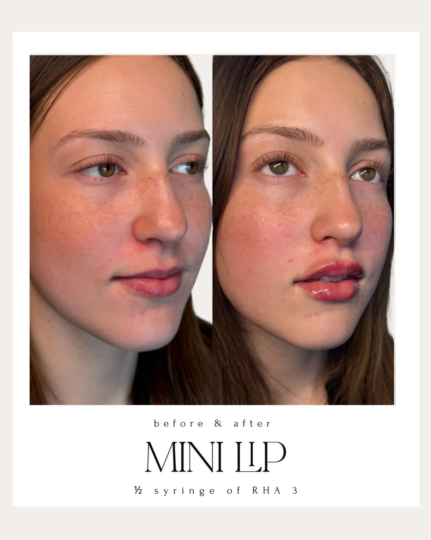 At Elite Derma, lip filler is never about &ldquo;bigger.&rdquo; It&rsquo;s about balance, structure, and enhancement of your natural shape.

As we age, we lose volume and support in the lips - causing flattening, inward curling, and less definition. 