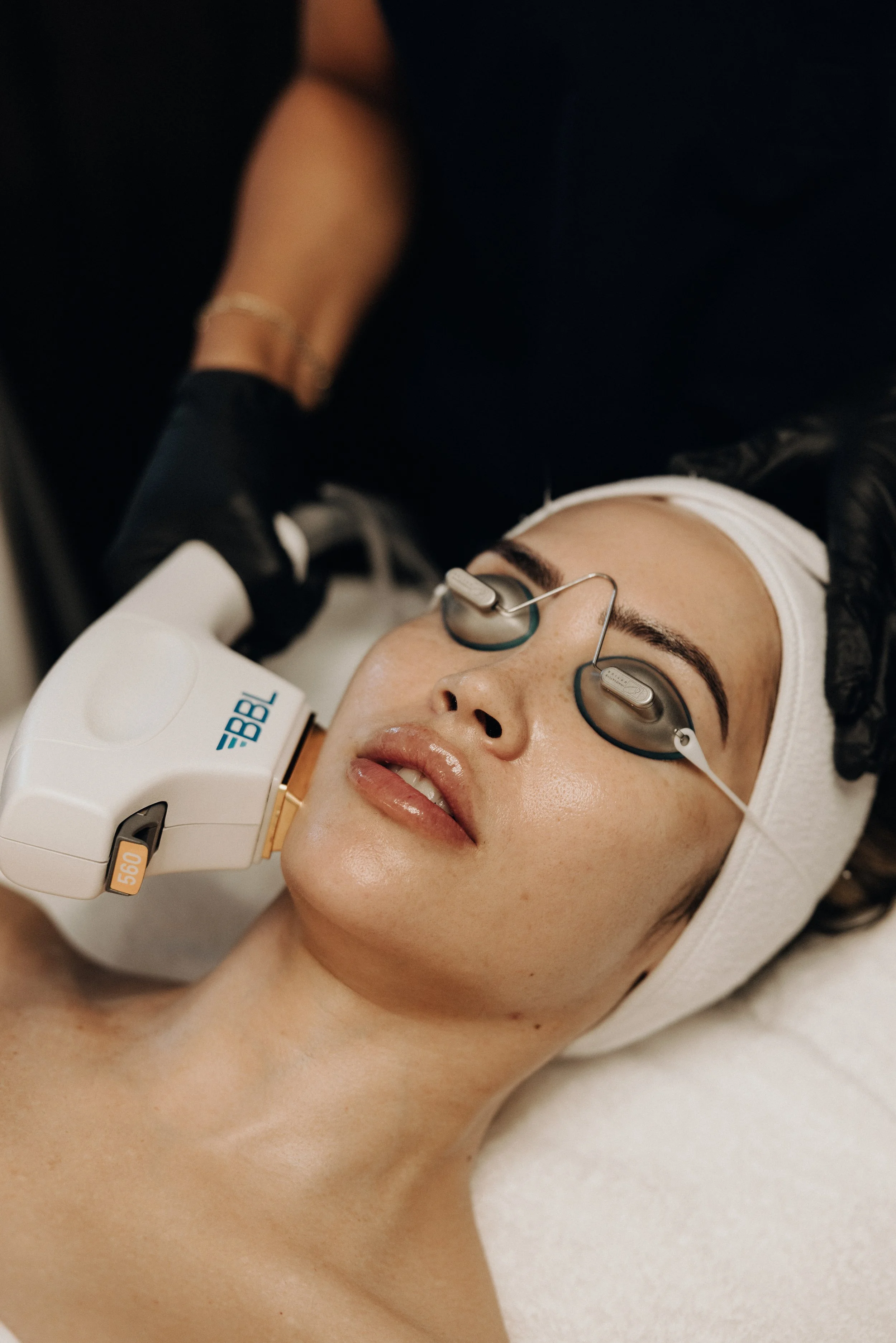 BBL Photofacial: The Gold Standard in Skin Rejuvenation