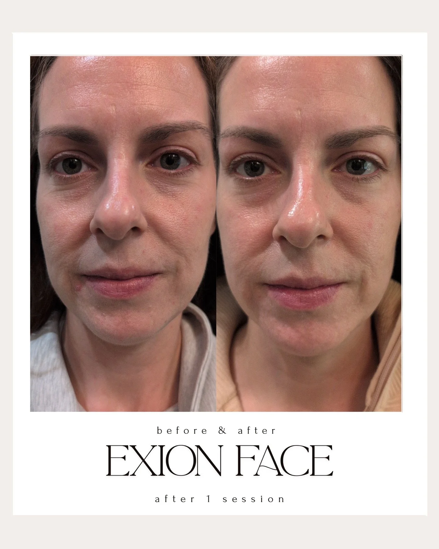 EXION Face ✨ Results After Just ONE Session! 

This is what true skin regeneration looks like.

After a single EXION Face treatment, we&rsquo;re already seeing:
&bull; Visible skin tightening
&bull; A smoother, more refined texture
&bull; Improvement