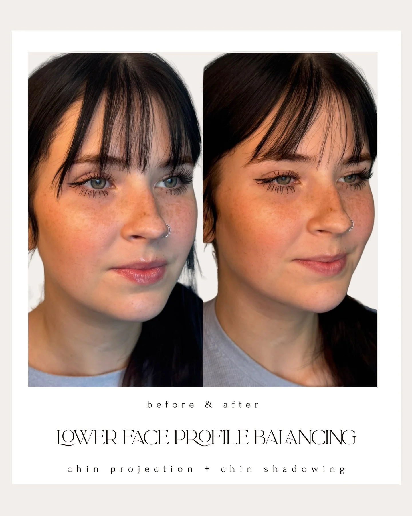 The power of a chin + chin shadow is often underestimated.
This isn&rsquo;t about making the chin &ldquo;bigger&rdquo; &mdash; it&rsquo;s about structure, balance, and light reflection in the lower face.

When the chin lacks support or projection, it