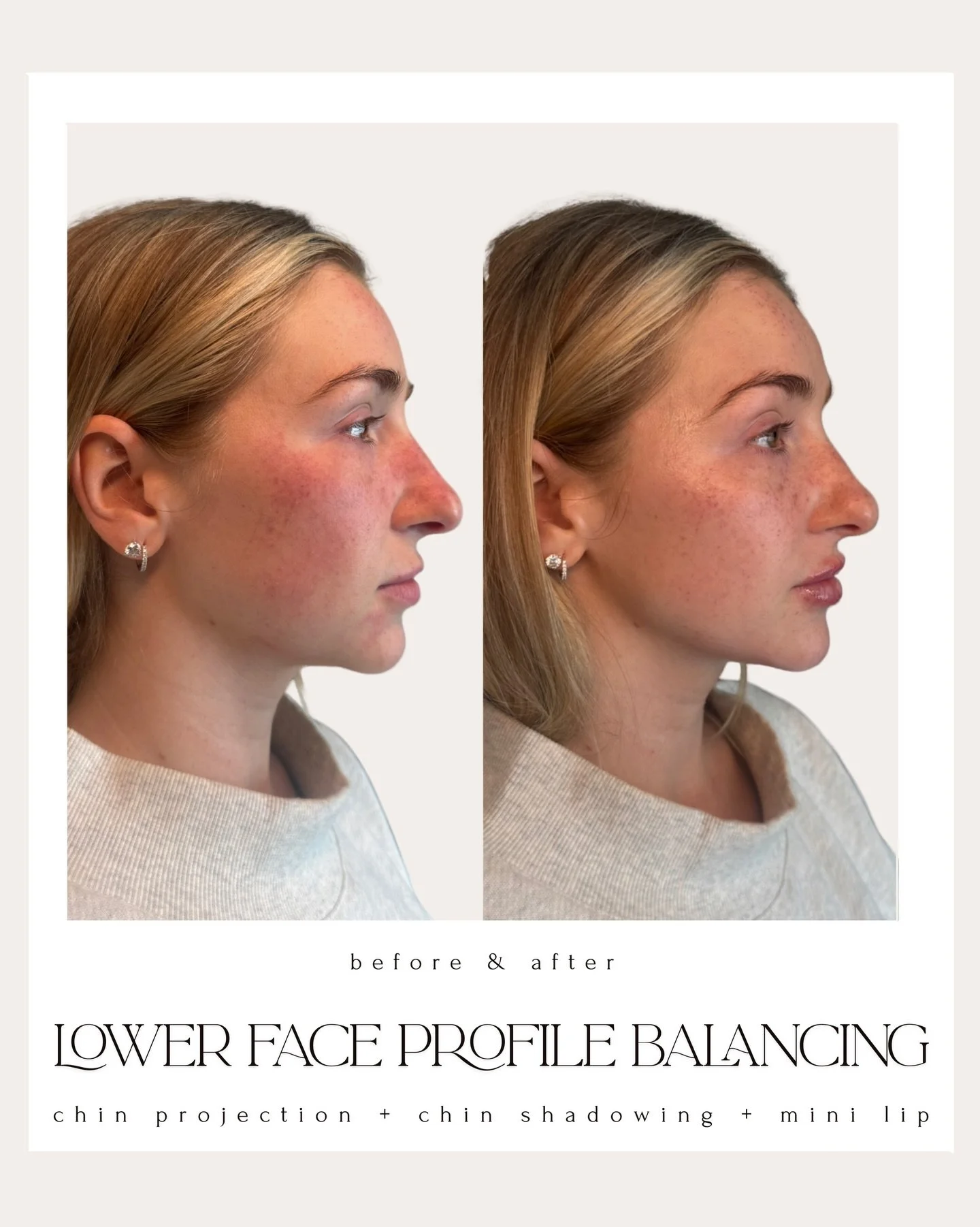 Lower Facial Balancing at Elite Derma Med Spa ✨
Lip Filler &bull; Chin Filler &bull; Chin Shadow Filler 
~ 6 weeks post PCDC injections for submental fullness. 

Lower facial balancing is all about harmony, not overfilling. We focus on how the lips, 