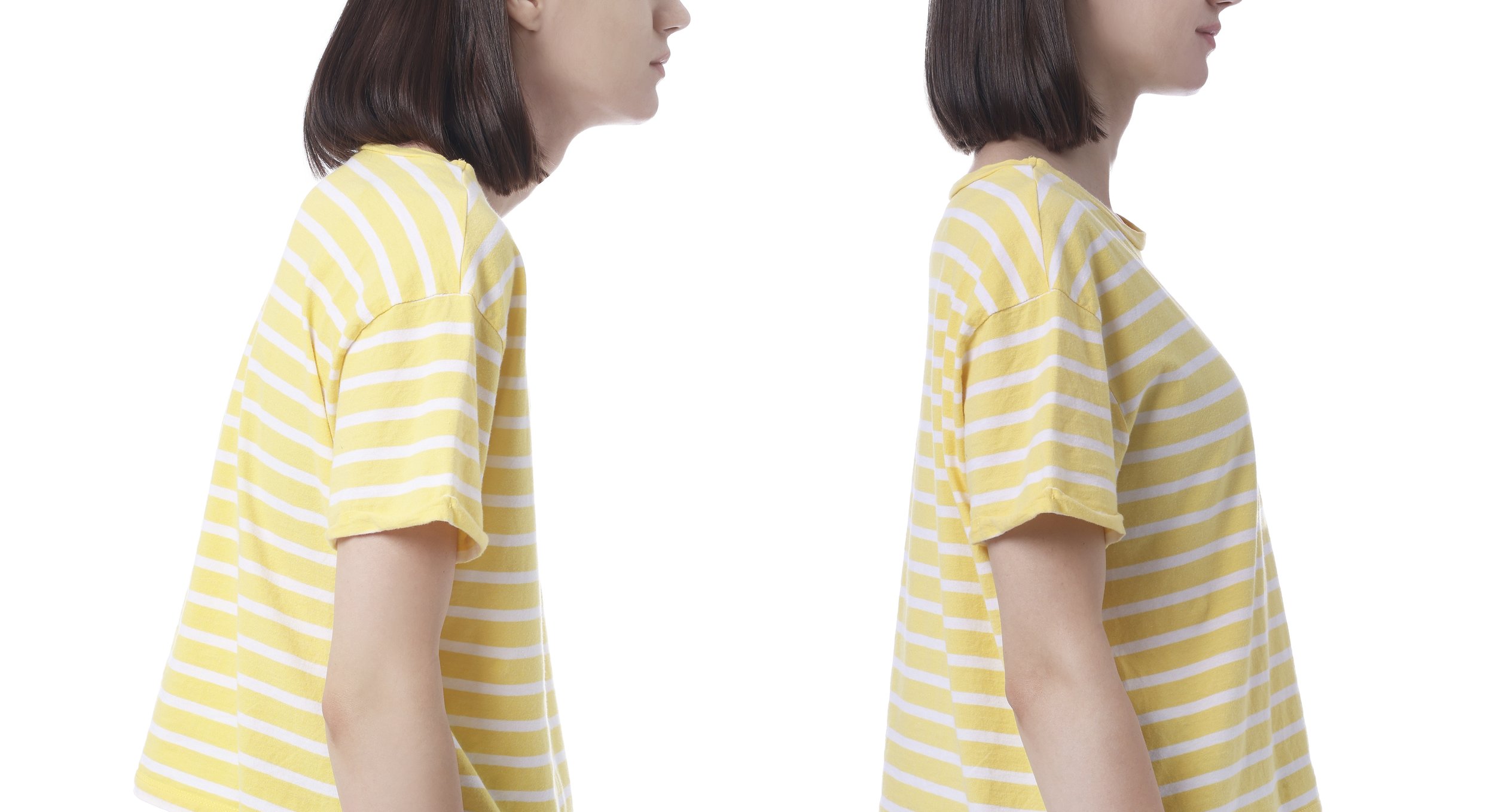 Scoliosis anatomy and the three-dimensional nature of the deformity