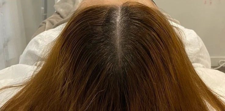 After hair result