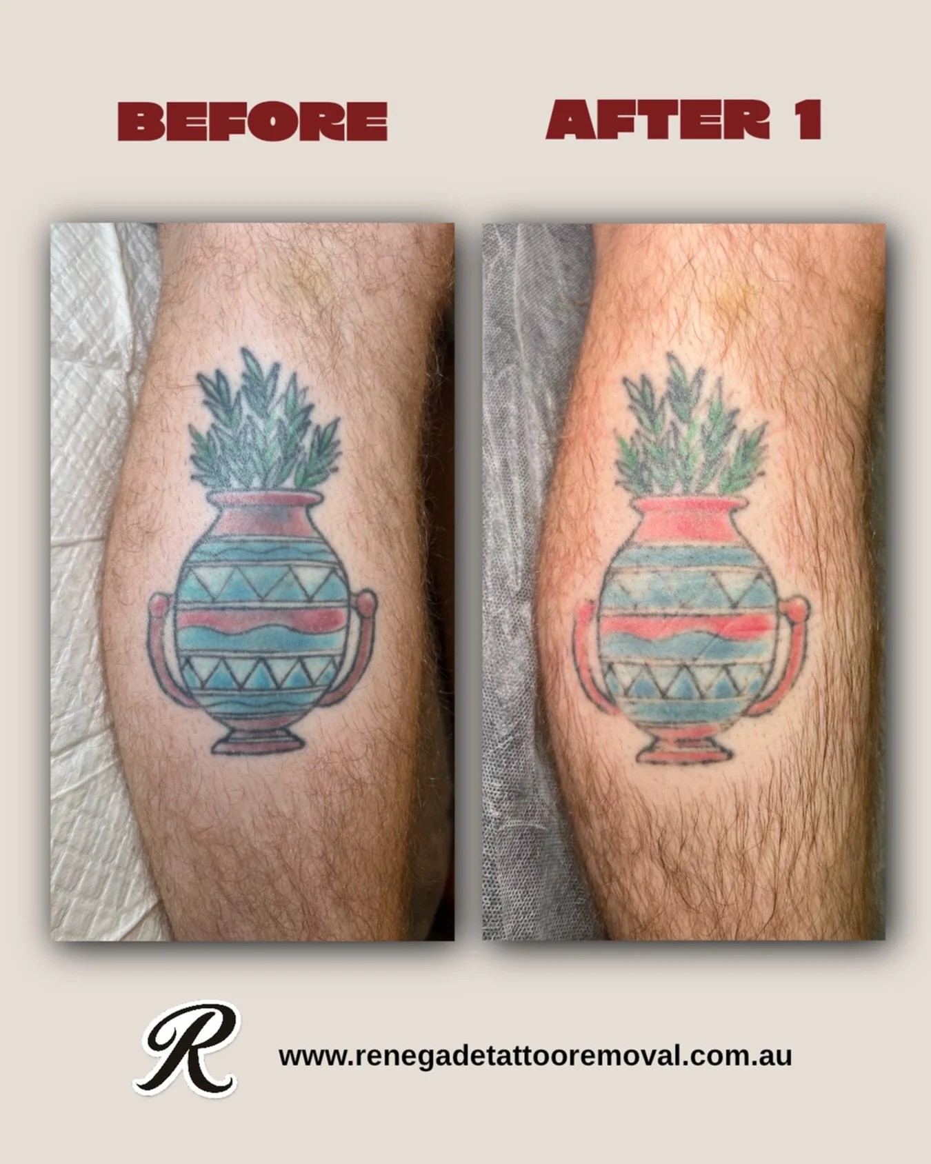 Another incredible result after just one session ⚡️

We used a combination of wavelengths to effectively target each colour yesterday and will give this tattoo a 12 week break before the next session. Our advanced technology is designed to treat the 