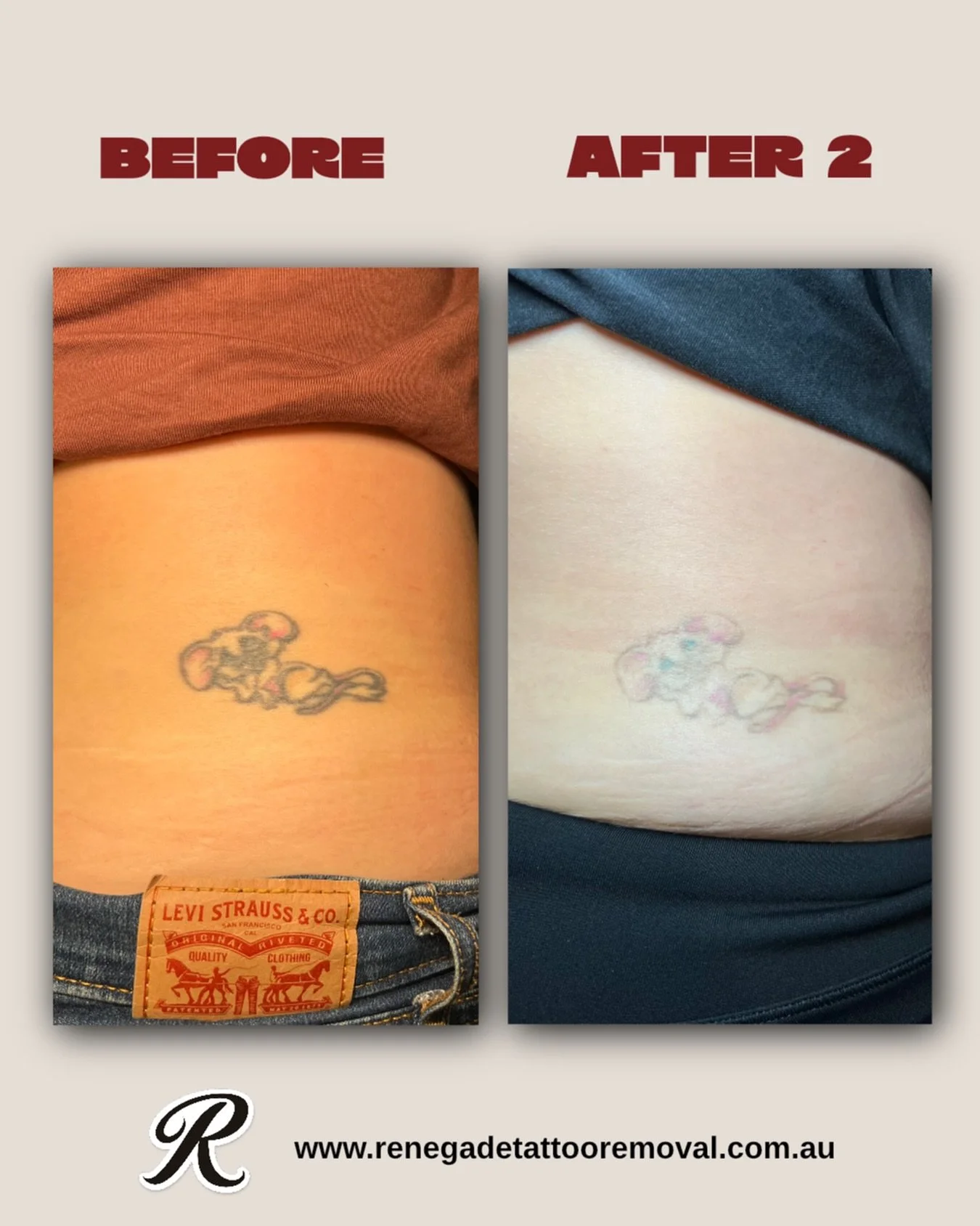 On the home stretch with this one⚡️ 

With 8 years of class 4 laser experience, a Graduate Diploma of Dermal Science and many years of experience in the dermal and tattoo industries - you know you&rsquo;re in the best possible hands. 

Book now via t