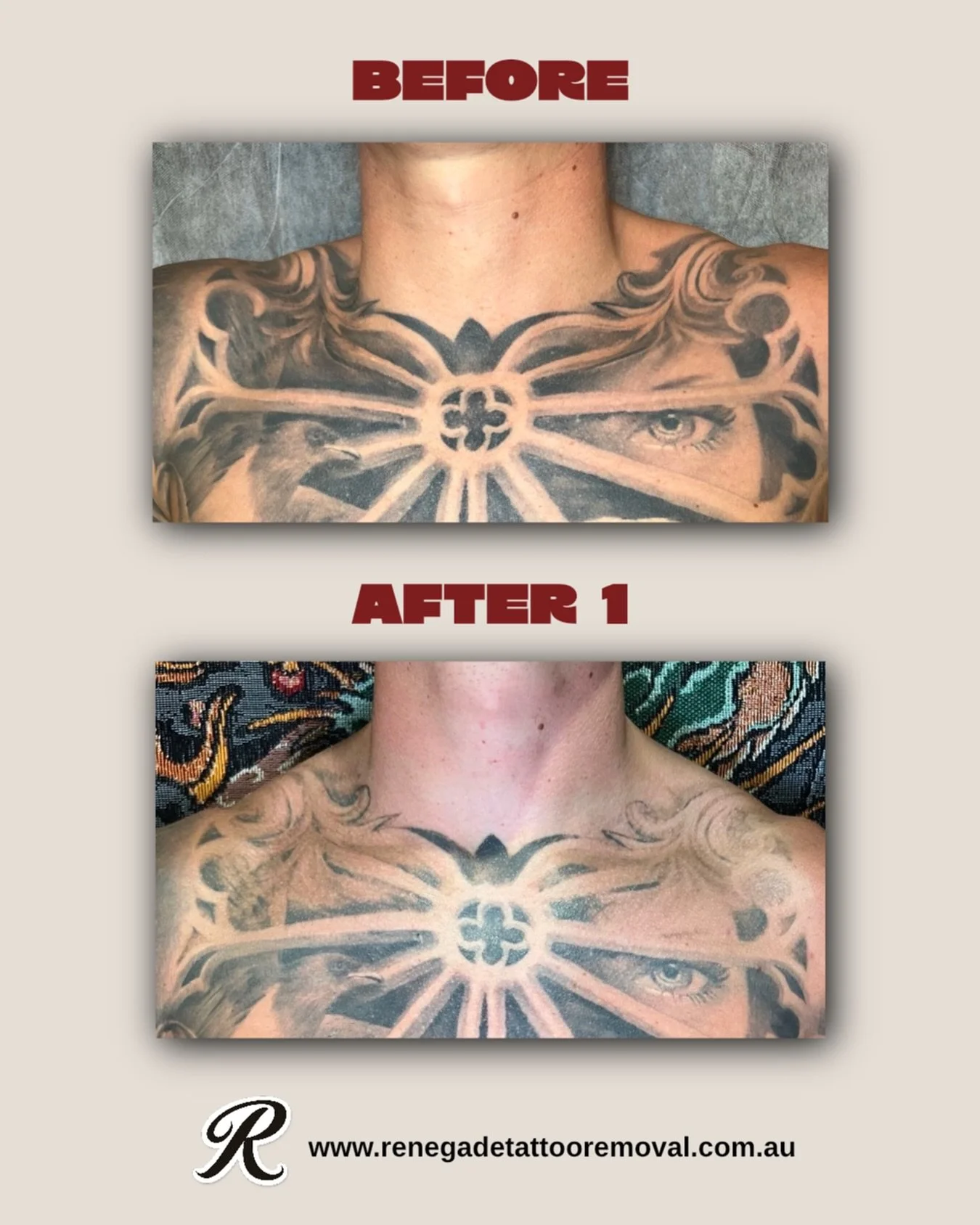 Unreal result after just one treatment to the top section of this chest piece. Can&rsquo;t wait to see how it goes after this session. 

Book now via the link in our bio or DM us for a no-obligation quote ⚡️

📍 North Perth | AE Studio
📲 0466 022 96