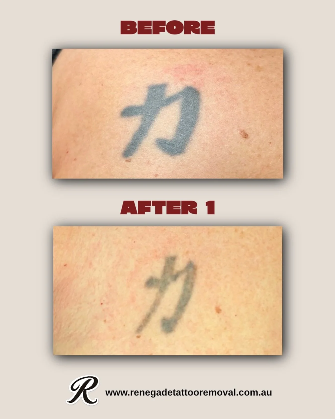 The results speak for themselves 😌

We have appointments available next week. Head to the link in our bio to book or DM/text us for a quote ✨

📍 North Perth | AE Studio
📲 0466 022 962
🌐 www.renegadetattooremoval.com.au