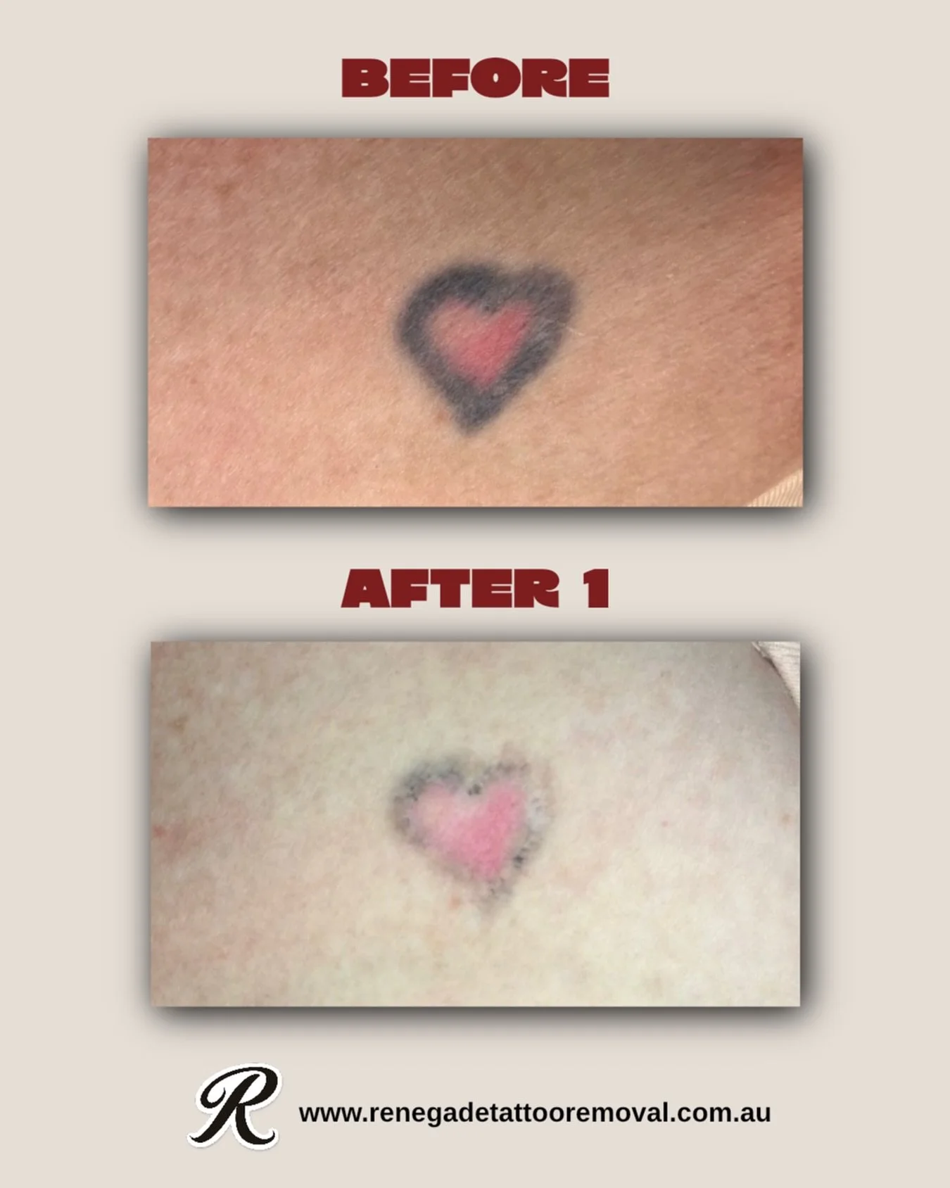 The before was definitely not doing us any favours (sorry about my terrible lighting situation) 🤣 but how good is this result after just ONE session on this little love heart 🥲

We&rsquo;ve now treated the pink and we&rsquo;re expecting only a few 